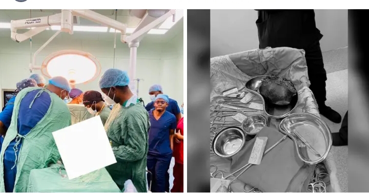 2.1kg testicular mass removed from 16-year-old at Levy Mwanawasa University Teaching Hospital
